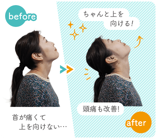 首が痛くて上を向けない… ちゃんと上を向ける!
