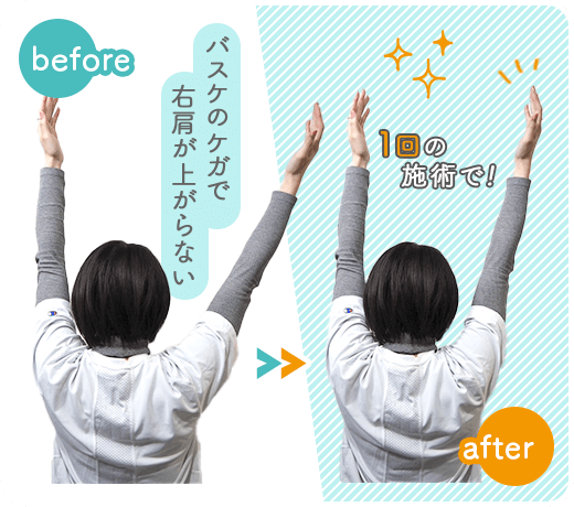 バスケのケガで右肩が上がらない 一回の施術で!