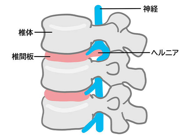椎間板ヘルニアのイラスト