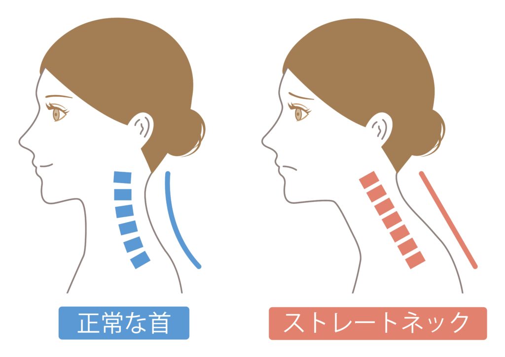 ストレートネック 女性
