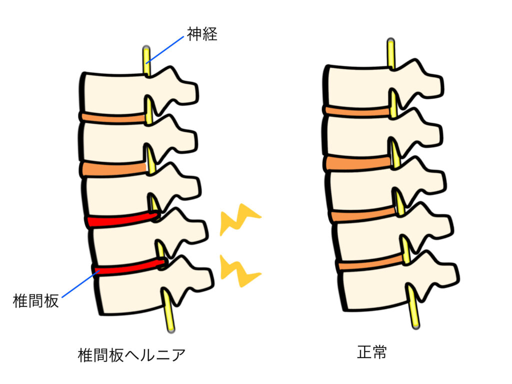椎間板ヘルニア