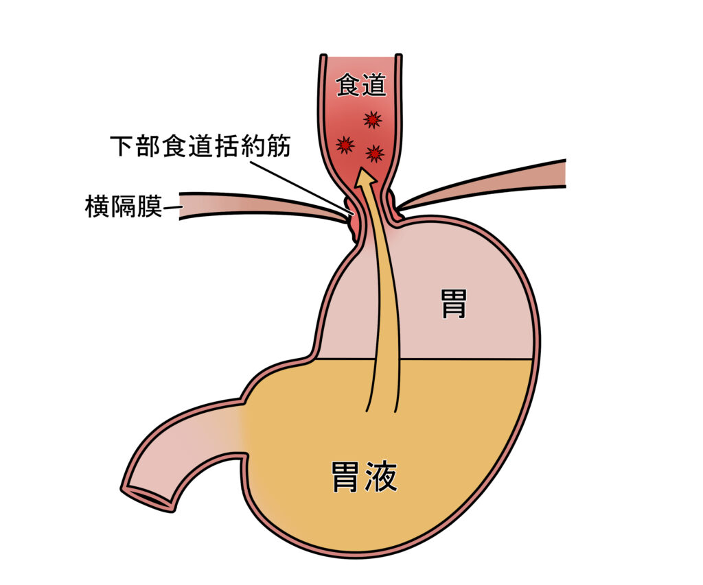 逆流性食道炎